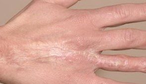 Systemic scleroderma